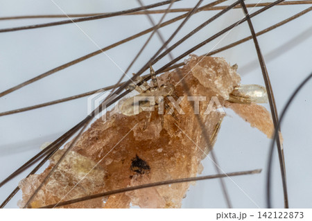 Human Head Louse and Nits (Pediculus humanus capitis) Attached to Human Hair Under Microscope | Microscopic Close-Up of Lice Infestation. Human Head Louse and Nits (Pediculus humanus capitis) Attached to Human Hair Under Microscope | Microscopic Close-Up of Lice Infestation. 142122873