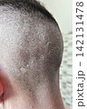 Close-up of shaved scalp with visible dandruff, peeling flakes, dry skin and small irritated bumps around short hair stubble 142131478