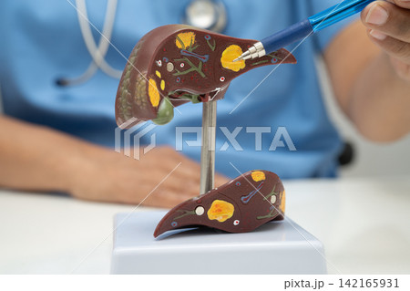 Cirrhosis, Liver cancer, fatty liver, Asian doctor with liver human model. 142165931