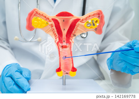 Doctor holding human uterus model for vaginal and cervix pap smear check up in the obstetrics and gynecology. 142169778