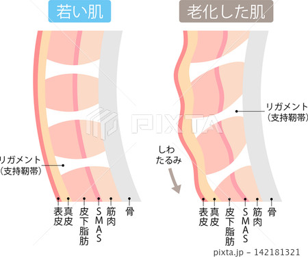 支持靭帯(リガメント )若い肌と老化した肌のしくみ 支持靭帯(リガメント )若い肌と老化した肌のしくみ 142181321