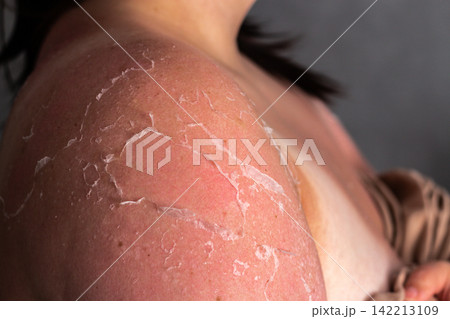Close up peeling skin and shedding old skin layers on shoulders and arms after sunburn. Visible UV damage. Result of not using SPF protection Close up peeling skin and shedding old skin layers on shoulders and arms after sunburn. Visible UV damage. Result of not using SPF protection 142213109
