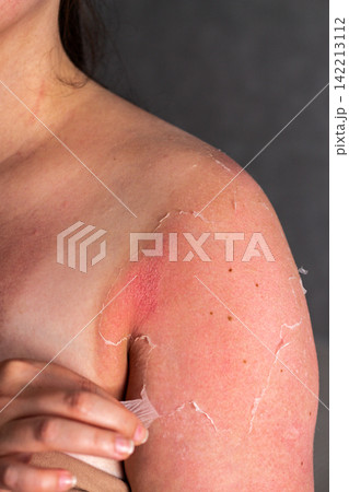 Woman with peeling skin on shoulders after sunburn. Red irritated patches from UV overexposure. Reminder to apply SPF cream and avoid peak sun hours for safety Woman with peeling skin on shoulders after sunburn. Red irritated patches from UV overexposure. Reminder to apply SPF cream and avoid peak sun hours for safety 142213112
