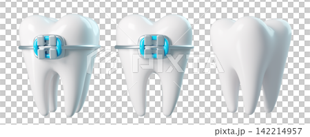 Set of 3d teeth with braces from different angles, bracket frame, realistic render icon isolated. Infographics installation of corrective brace Set of 3d teeth with braces from different angles, bracket frame, realistic render icon isolated. Infographics installation of corrective brace 142214957