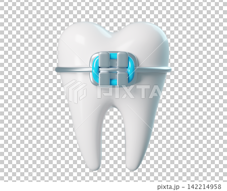 3d Tooth with a braces, bracket frame, realistic render icon isolated. Infographics installation of corrective brace 3d Tooth with a braces, bracket frame, realistic render icon isolated. Infographics installation of corrective brace 142214958