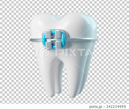 3d Tooth with a braces, bracket frame, realistic render icon isolated. Infographics installation of corrective brace 3d Tooth with a braces, bracket frame, realistic render icon isolated. Infographics installation of corrective brace 142214959