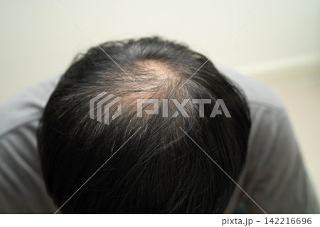 Bald head in man, hair loss treatment health problem. Bald head in man, hair loss treatment health problem. 142216696