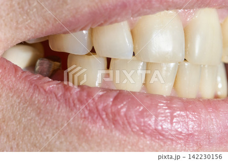 Human Mouth Smiling With Visible Dental Crown And Teeth Side Profile Clinical Indoor Environment Human Mouth Smiling With Visible Dental Crown And Teeth Side Profile Clinical Indoor Environment 142230156
