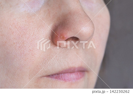 Woman Side Nose Close Up Showing Scab On Nostril And Surrounding Skin Texture With Neutral Lips 142230262