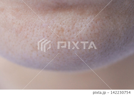 Lower Face Chin Showing Clustered Open Pores And Uneven Texture In Macro Close Up Clinical Setting Lower Face Chin Showing Clustered Open Pores And Uneven Texture In Macro Close Up Clinical Setting 142230754
