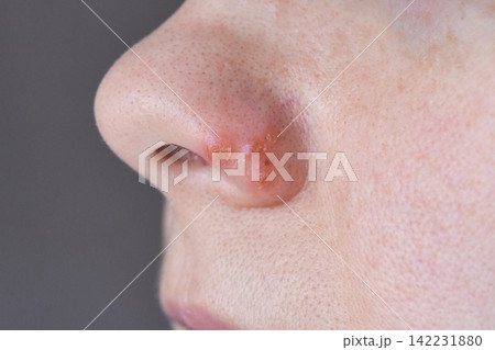 Nose Showing Crusted Sores And Localized Inflammation Near Nostril On Facial Skin Closeup Clinical Nose Showing Crusted Sores And Localized Inflammation Near Nostril On Facial Skin Closeup Clinical 142231880