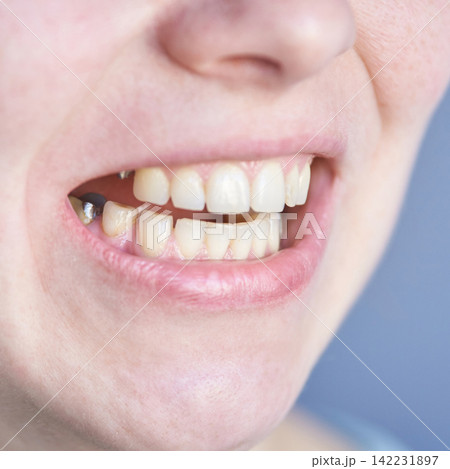 Close Up Of Person Open Mouth Showing Missing Tooth Gap And Metal Dental Fillings During Dental 142231897