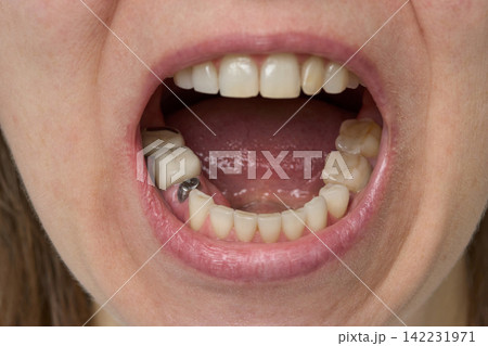Patient Lower Jaw With Dental Implant Abutment Visible In Frontal Open Mouth View During Dental Patient Lower Jaw With Dental Implant Abutment Visible In Frontal Open Mouth View During Dental 142231971