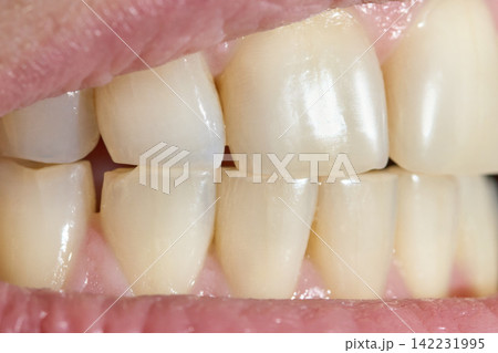 Healthy Looking Human Teeth In Bite Close Up Frontal View Dental Alignment Natural Lighting 142231995