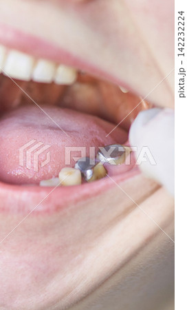 Lower Molars Metal Crowns Exposed During Oral Examination Inside Patient Mouth Clinical Close Up Lower Molars Metal Crowns Exposed During Oral Examination Inside Patient Mouth Clinical Close Up 142232224