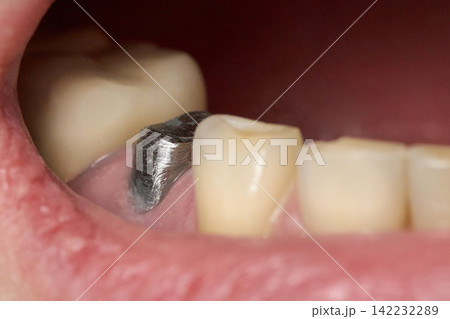 Close Up Lower Molar Area Showing Exposed Dental Implant Abutment And Adjacent Natural Teeth Inside Close Up Lower Molar Area Showing Exposed Dental Implant Abutment And Adjacent Natural Teeth Inside 142232289