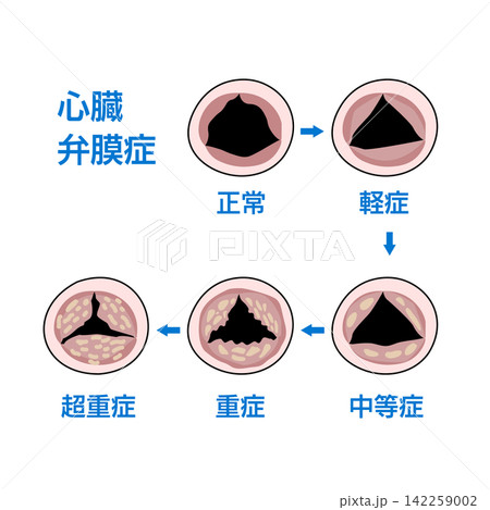 心臓弁膜症の進行度を示す正常と異常な弁の医療図解 142259002