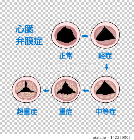心臓弁膜症の進行度を示す正常と異常な弁の医療図解 142259002