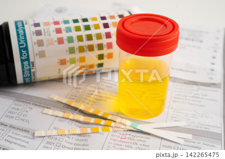 Urinalysis, urine cup with reagent strip pH paper test and comparison chart in laboratory. Urinalysis, urine cup with reagent strip pH paper test and comparison chart in laboratory. 142265475