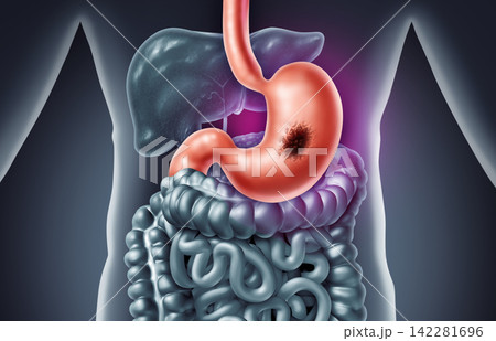 Stomach Tumor Stomach Tumor 142281696