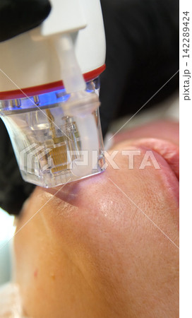 A multifunctional device for microneedle RF lifting. Aesthetic procedures for non-surgical lifting, smoothing fine lines, minimizing pores, regulating sebum production, and evening out skin texture. 142289424