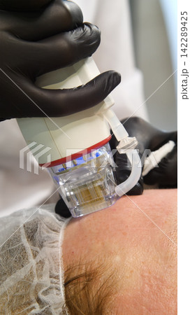 A multifunctional device for microneedle RF lifting. Aesthetic procedures for non-surgical lifting, smoothing fine lines, minimizing pores, regulating sebum production, and evening out skin texture. A multifunctional device for microneedle RF lifting. Aesthetic procedures for non-surgical lifting, smoothing fine lines, minimizing pores, regulating sebum production, and evening out skin texture. 142289425