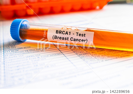blood sample in lab test tube for BRCA1 Breast Cancer blood sample in lab test tube for BRCA1 Breast Cancer 142289656