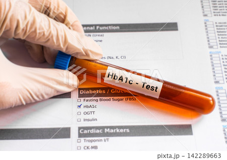 blood sample in lab tube for HbA1c test 142289663