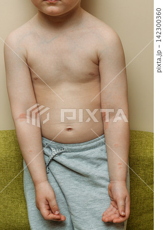 Young boy showing skin irritation on his inner elbows. Young boy showing skin irritation on his inner elbows. 142300360