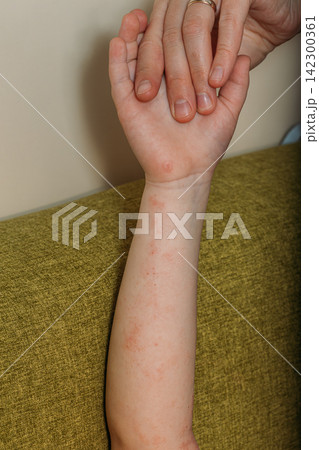 Child's arm showing red, irritated skin from a dermatitis flare-up. Child's arm showing red, irritated skin from a dermatitis flare-up. 142300361