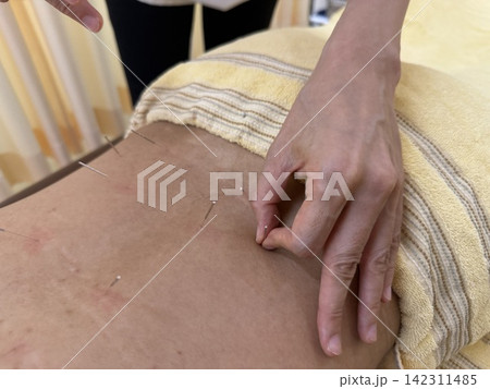 鍼灸 鍼灸 142311485