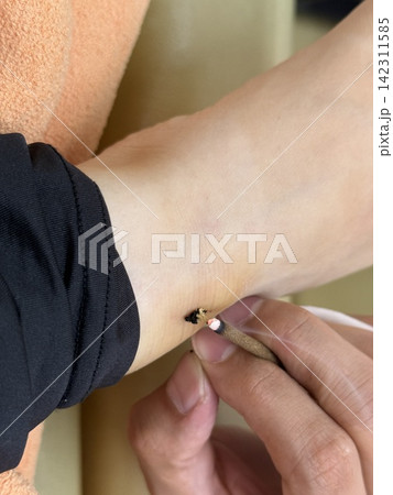 鍼灸 鍼灸 142311585
