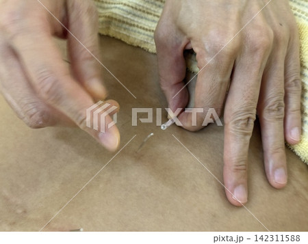 鍼灸 鍼灸 142311588
