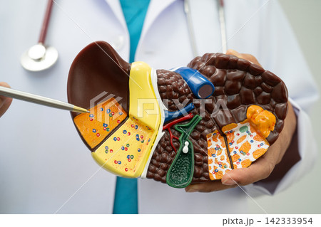 Cirrhosis, Liver cancer, fatty liver, Asian doctor with liver human model. 142333954