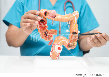 Colorectal cancer, doctor holding intestine colon human anatomy model. Colorectal cancer, doctor holding intestine colon human anatomy model. 142360258