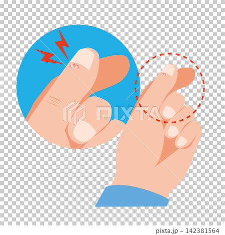 Hangnail on the thumb Hangnail on the thumb 142381564