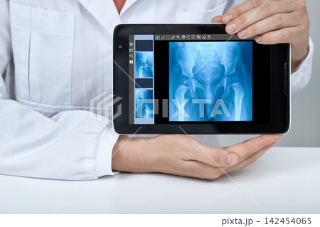 Medical professional holding a digital tablet showing a pediatric pelvic X-ray radiography for evaluating hip joint formation and detecting congenital dislocation Medical professional holding a digital tablet showing a pediatric pelvic X-ray radiography for evaluating hip joint formation and detecting congenital dislocation 142454065
