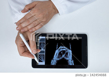 Doctor pointing with a pen at a digital hand bone X-ray on a tablet screen. Rheumatoid arthritis symptoms, joint inflammation, and hand deformity checkup. Doctor pointing with a pen at a digital hand bone X-ray on a tablet screen. Rheumatoid arthritis symptoms, joint inflammation, and hand deformity checkup. 142454088