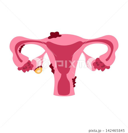 endometriosis organ infection ovary illustration endometriosis organ infection ovary illustration 142465845