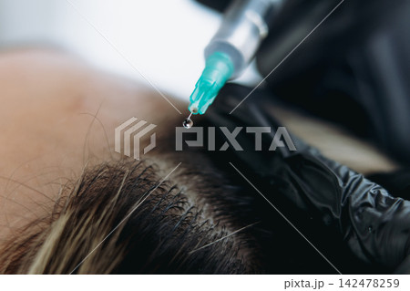 close up on woman head getting mesotherapy injections for stronger and healthier hair close up on woman head getting mesotherapy injections for stronger and healthier hair 142478259