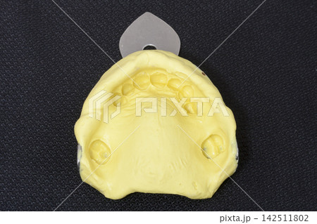 oral rehabilitation process, partial removable prosthesis oral rehabilitation process, partial removable prosthesis 142511802