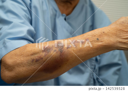 Ecchymosis, elderly bleeding on her arm after taking aspirin. 142539328