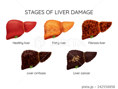 Liver damage from healthy to cirrhosis with six labelled stages, with liver, liver damage, healthy, fatty detail, showing steatosis, moderate, advanced, severe Liver damage from healthy to cirrhosis with six labelled stages, with liver, liver damage, healthy, fatty detail, showing steatosis, moderate, advanced, severe 142550856