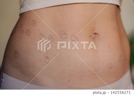 Marked red skin spots on woman abdomen for home rash monitoring 142556271