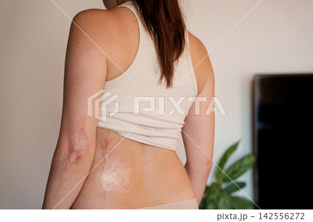 Burn scars on woman back and elbow shown as skin healing detail Burn scars on woman back and elbow shown as skin healing detail 142556272