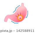 胃潰瘍で痛む胃 142588911