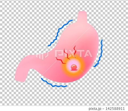胃潰瘍で痛む胃 142588911