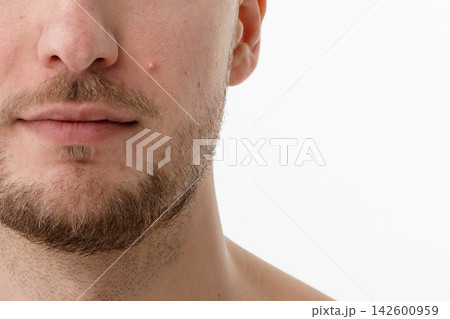Close-Up of Human Skin with Acne and Blemishes Close-Up of Human Skin with Acne and Blemishes 142600959