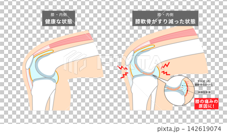 An anatomical diagram showing how the knee joint and knee cartilage wear down. An anatomical diagram showing how the knee joint and knee cartilage wear down. 142619074