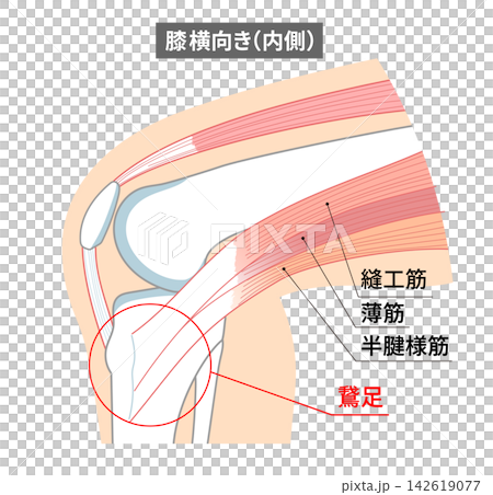 膝關節內側鵝足以及縫匠肌、股薄肌和半腱肌的解剖圖。 膝關節內側鵝足以及縫匠肌、股薄肌和半腱肌的解剖圖。 142619077